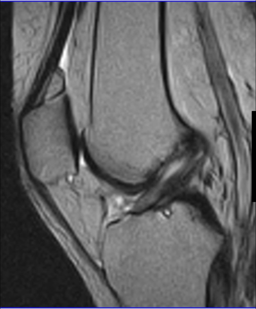 Images for this section: Fig. 1: T2W sagital image: low grade (grade I sprain) of the ACL.