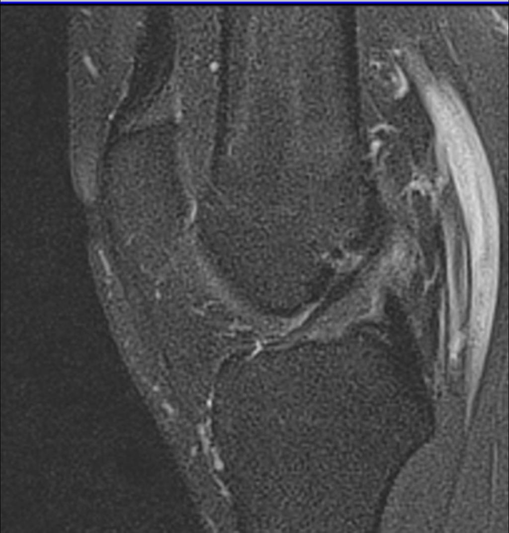 Fig. 2: Sagital DP FAT SAT WI: grade I ACL injury with tendon thickening and high signal