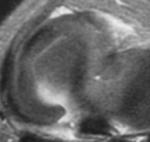 ligament avulsion Radial tear of meniscus Complete