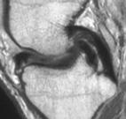 Centrally displaced meniscal tissue Continuity of anterior and posterior horns with displaced meniscal tissue Bucket -
