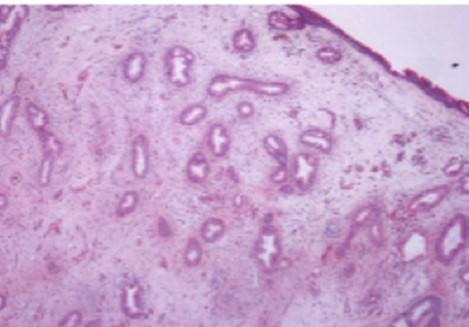 EUROMEDITERRANEAN BIOMEDICAL JOURNAL 2018,13 (12) 060 064 63 Figure 8 - Histological examination of the surgical specimens highlighted the simultaneous presence of inflammatory polyps and REAH.