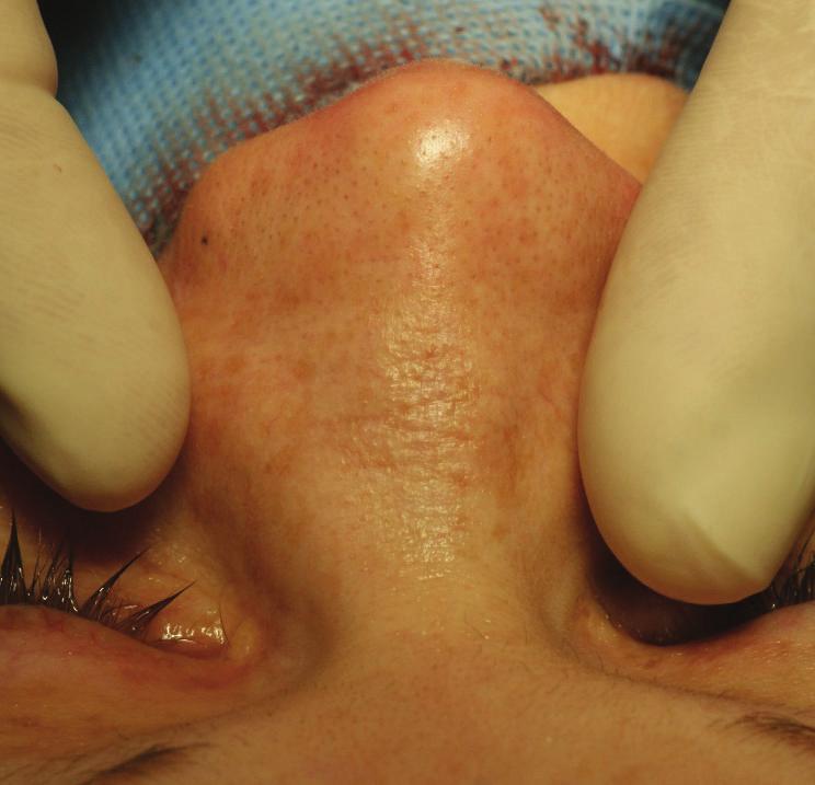 deformity limited to the paranasal sinuses. This case documents the development of the condition over a period of more than 10 years during adulthood.
