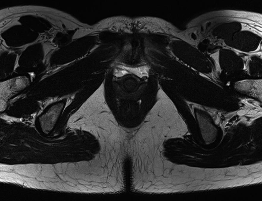 Magnetic Resonance Imaging of Pelvic Floor for SUI in Primiparous Women was used in these cases.