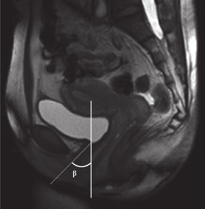 The widening of the proximal urethra and funneling at the vesical neck was defined as the implication of urethral sphincter dysfunction (Fig. 4).