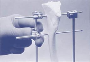 the diameter of the bone being stabilized. 2. Full pins (penetrating both the cis- and trans-cortex) should be used when possible.
