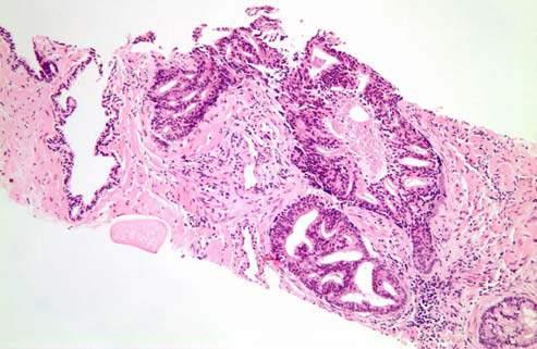 Intraductal Carcinoma of the Prostate Significance of IDC-P in Prostate Biopsy IDC-P in prostate