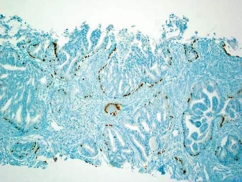 adenocarcinoma of the prostate Intraductal