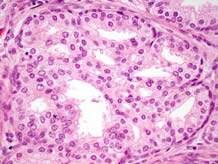 mistaken for HGPIN; unlikely to be confused with PCa Pseudostratified nuclei; eosinophilic cytoplasm; prominent basal cells Part of BPH; seen in transition