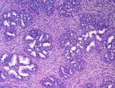 Basal Cell Hyperplasia Part of BPH; seen in