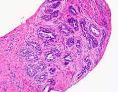 Prostate Biopsies Cribriform Lesions in Prostate