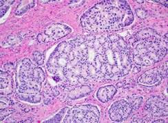 PCa All cribriform cancer gland are, regardless of