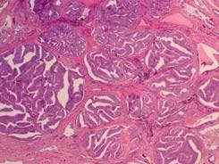 Ductal Adenocarcinoma of the Prostate Glands lined