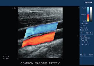 carotid artery While the HD6 delivers impressive capabilities, it also delivers a surprisingly low price that make it the perfect