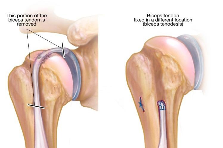 Shoulder Arthroscopy Procedures Biceps Tenodesis Biceps tenodesis is a procedure during which the surgeon cuts the attachment of the biceps tendon to the labrum (cartilage around shoulder socket) and
