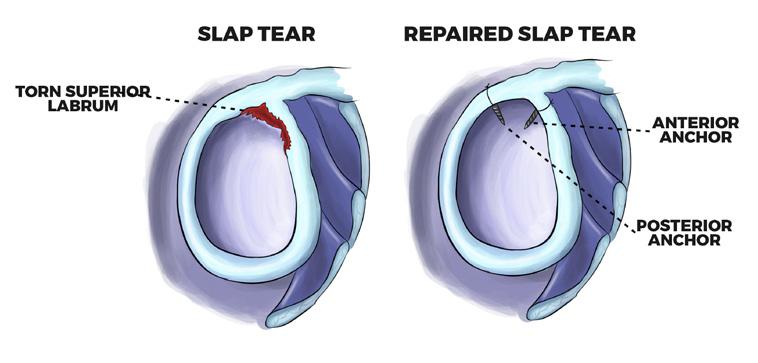 A tear of the rim below the middle of the shoulder socket that also involves the inferior glenohumeral ligament is called a Bankart lesion.