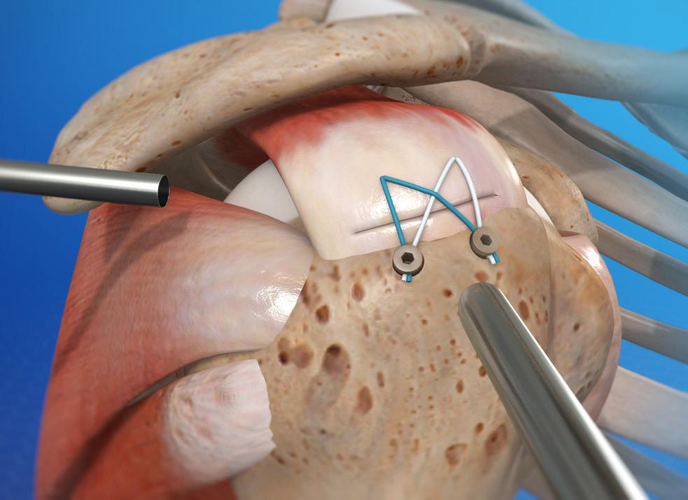 During arthroscopic surgery, the doctor will examine the rim and the biceps tendon. If the injury is confined to the rim itself, without involving the tendon, the shoulder is still stable.