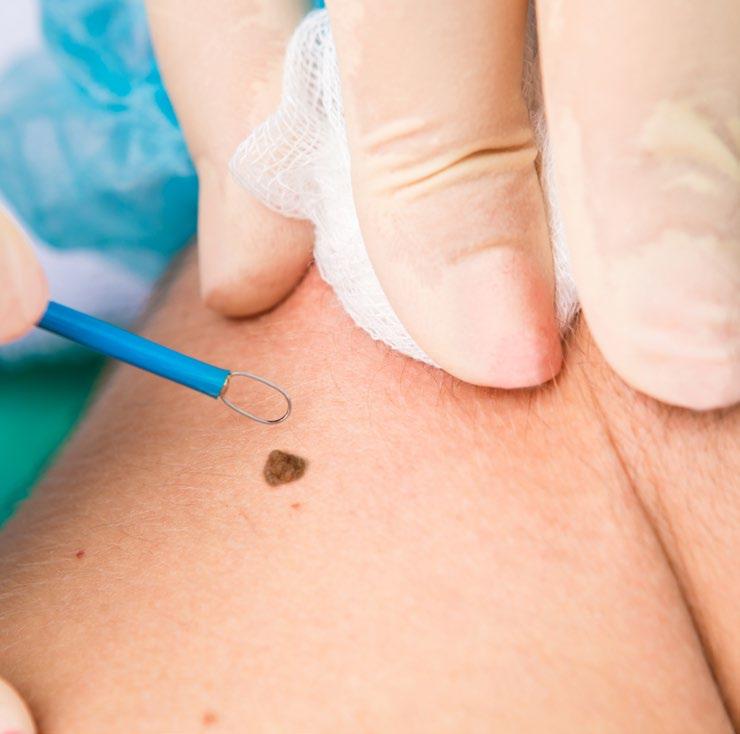 The area treated with radiosurgery for mole removal will remain red from one to three months on average, depending on the natural colouring of the skin (those with a fairer complexion will see