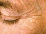 Matyunin Periocular wrinkles, courtesy of R.