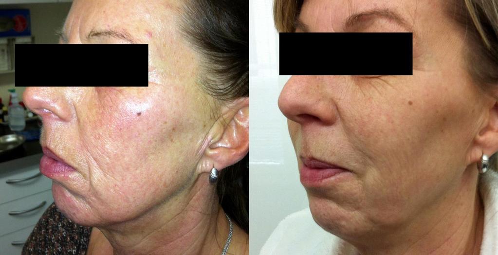 Indications Fractional - Scanner Skin rejuvenation MP PRO 100 0518