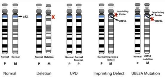 Genetic Mechanisms that Cause AS In 1997, mutations in the gene, UBE3A located on chromosome 15, were identified as the cause of AS.
