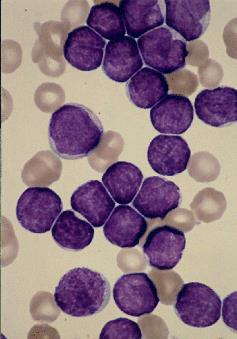 leukemia (ALL); Proliferation of