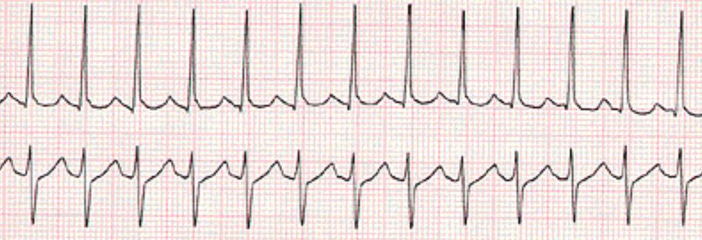 SVT - Supra Ventricular Tachycardia Coronary Arteries Overview LMS Supraventricular tachycardia is defined as an abnormally fast heartbeat.