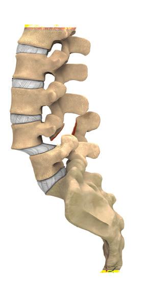 Degenerative spondylolisthesis most commonly occurs in the lower back (lumbar