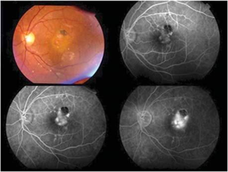 Retina: Anti VEGF Agents in Retinal Disorders Current Scenario Pretreatment ( 5/60, N36) Post anti VEGF Monotherapy (6/12, N8) Figure 1: Pretreatment and Posttreatment FFA and OCT of a patient with