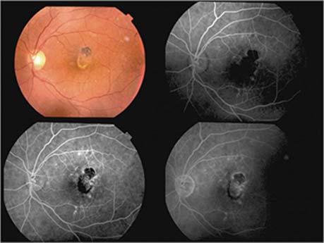 Patient has been subsequently stable for 2 years after last injection antibody Ranibizumab In the treatment of Neovascular of predominantly Classic CHORoidal Neovasularization of patients lost fewer