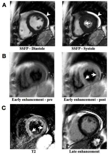 Cardiovascular magnetic resonance in myocarditis: A JACC White Paper. Cine imaging Edema.
