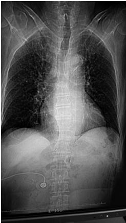 Image Guided Stereotactic Radiotherapy of the Lung Jamie Marie Harris, MS DABR Avera McKennan Radiation Oncology September 25, 2015 Stereotactic Body Radiotherapy - Clinical Dose/Fractionation