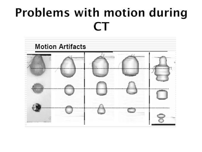 Tumor spatial motion is greatest in superior-inferior direction (average ~15mm), particularly for lower-lobe unfixed tumors Expected lateral and anterior-posterior motion is ~5mm, but this can vary