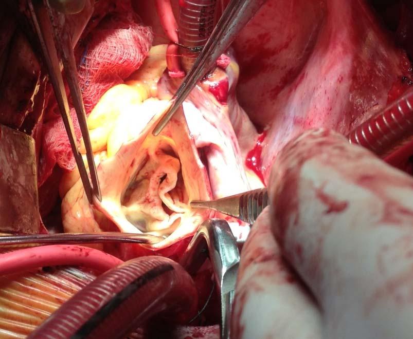 Use of Pericardial Patch for Reconstruction