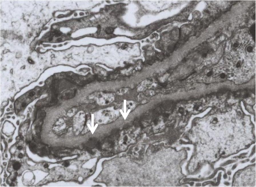 Taguchi et al. BMC Nephrology (2019) 20:43 Page 3 of 6 Fig. 1 Microscopic findings of the glomeruli in the kidney. Periodic acid-methenamine silver staining shows no obvious abnormality (a).