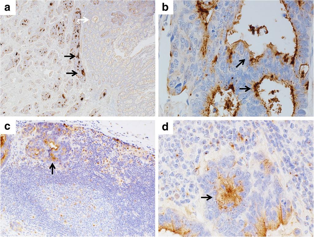 Taguchi et al. BMC Nephrology (2019) 20:43 Page 4 of 6 Fig. 3 THSD7A staining in the rectal cancer, and metastatic lymph node.