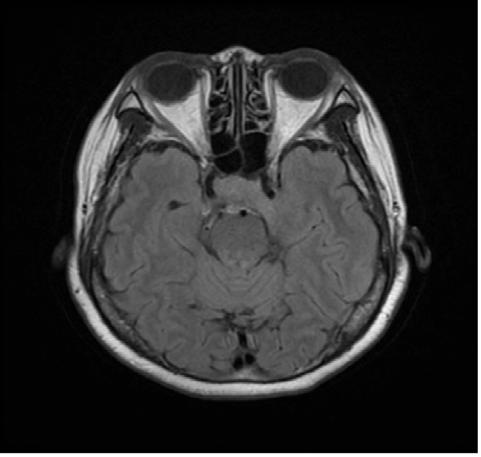 Figure 3 Head and neck MRI findings.