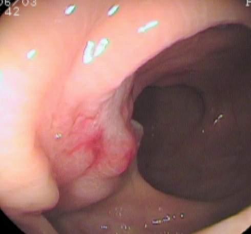 is suggested to evaluate sigmoid- rectal lumen and biopsy