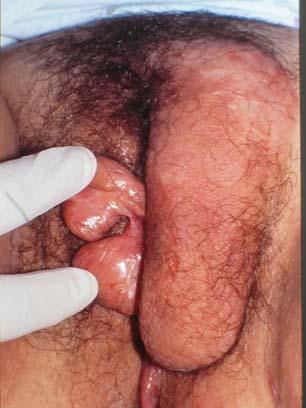 Crohn s with Edema Treatment of Vulvar Crohn s