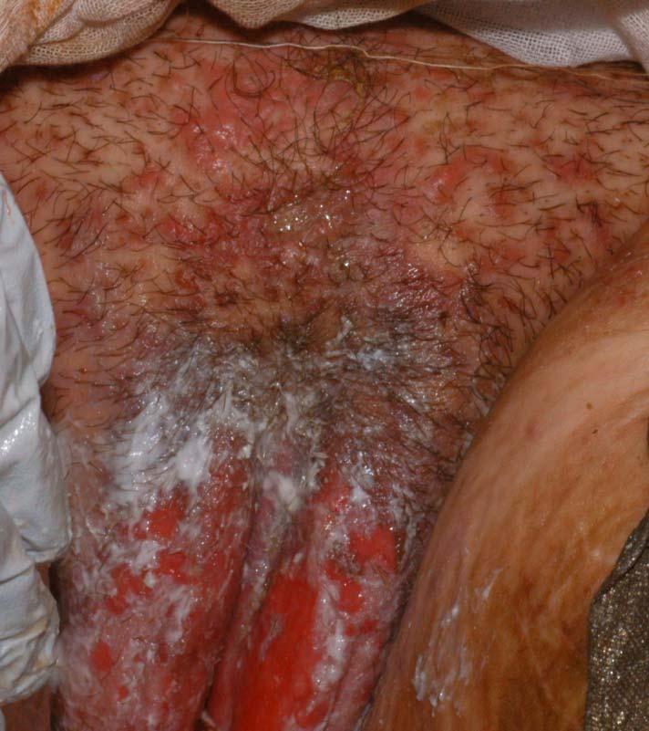 Toxic Epidermal Necrolysis (TEN) Toxic Epidermal Necrolysis (TEN) A serious, life-threatening allergic skin rash to medication