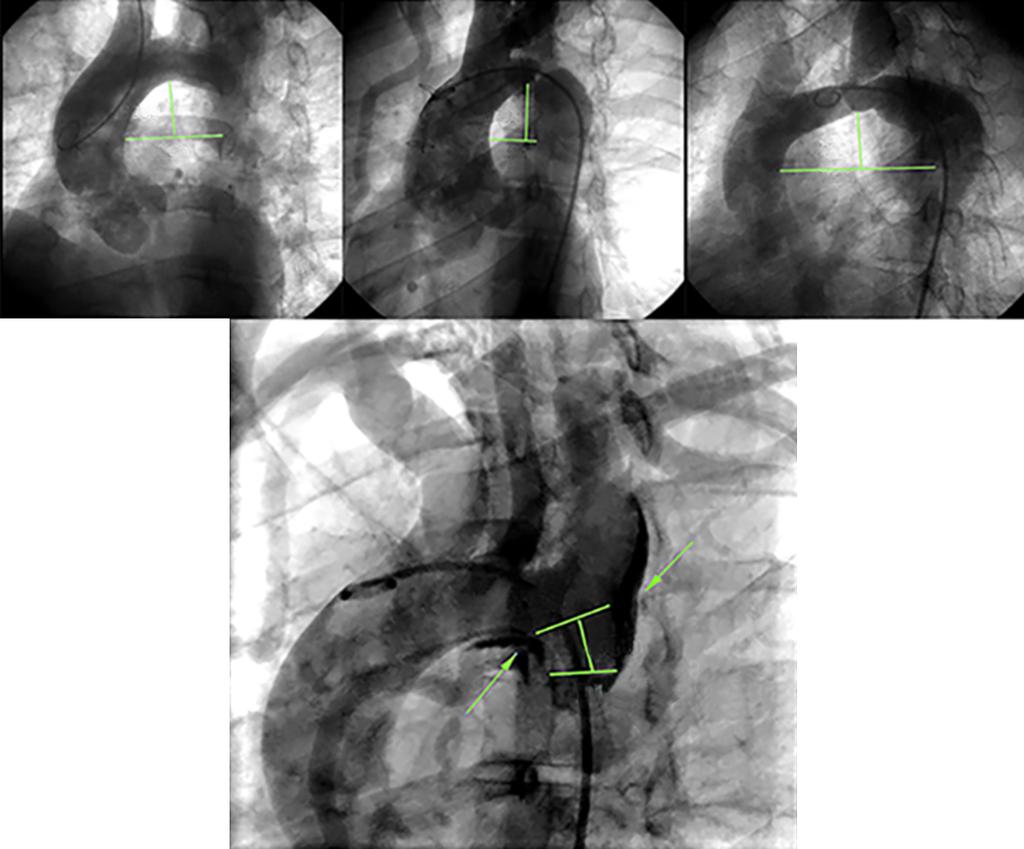 98 Early and Midterm Results Following Stent Coarctoplasty Height Width Height Width Height Width A B C SCA origin Length Initial part of coarctation D Fig. 1. Anatomical variants of the aortic arch.
