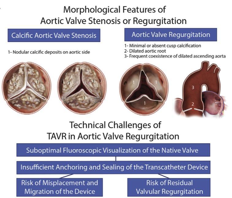 Aortic regurgitation Prevalence in Framingham study 4.9%, moderate or severe 0.