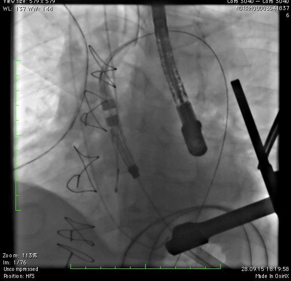 valve and no residual VSD Engager Transapical Engager