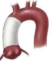 AR patients differ from AS patients Younger patients Etiology: Endocarditis Large root disease Aorta disease Bicuspid