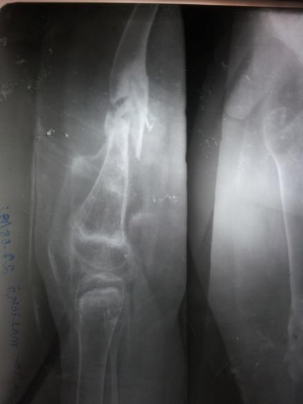 Case 3: Osteomyelitis distal femur with