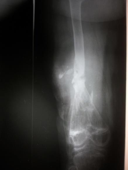 Case 4: Compound fracture tibia with bone loss.