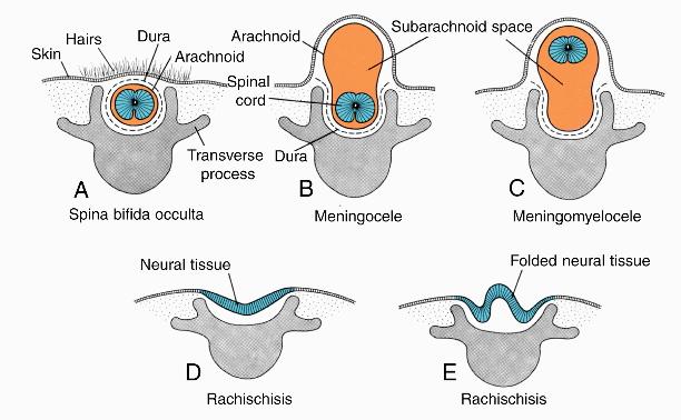 Various Types of Spina Bifida (Ra-kis -ki-sis) Neural