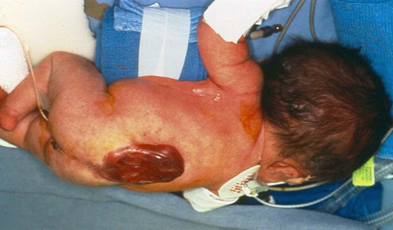 Meningomyelocele with associated hydrocephalus The malformation of the spinal cord results in a portion of the brainstem and/or cerebellum to be pulled