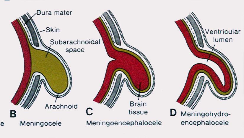 Types of Encephaloceles Encephaloceles result from a failure of closure of