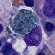 Participants Identification No. % Evaluation BMD-13 Macrophage containing hemosiderin 172 71.4 Educational Macrophage (histiocyte) 25 10.4 Educational Histiocyte, sea blue 23 9.