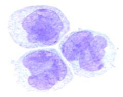 Certain cases with less than 20% blasts can be classified as acute myeloid leukemia when specific cytogenetic abnormalities are present as well as cases of acute erythroid leukemia.